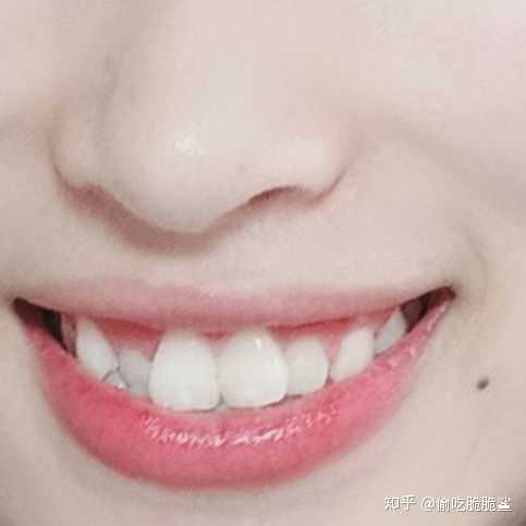 门牙太大是一种怎样的体验?