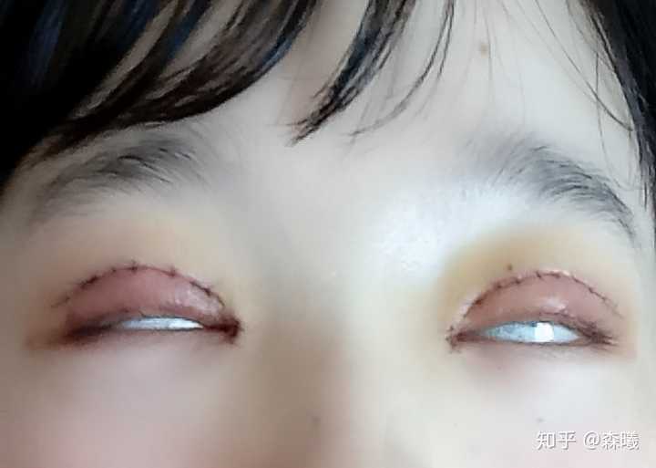 全切双眼皮手术恢复记录