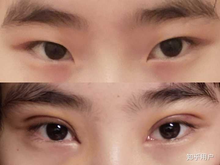 割双眼皮是种怎样的体验