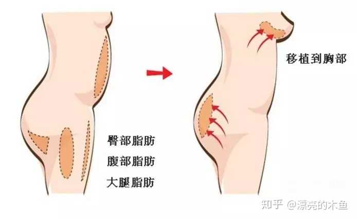 隆胸都有哪些危害?
