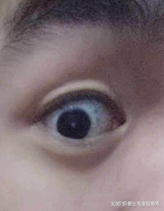 瞪眼法真的会变双眼皮么我假性双眼皮?