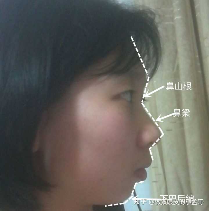 4mm;侧面看鼻山根较低,中国女性标准鼻根高度是11mm,鼻梁高度侧面看还