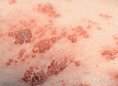 得了带状疱疹的症状及感受是什么?