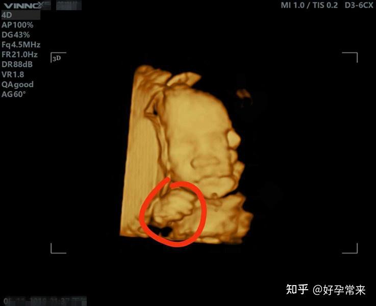 好孕常来 的想法: 孕24周 3做大排畸,检查过程中胎儿
