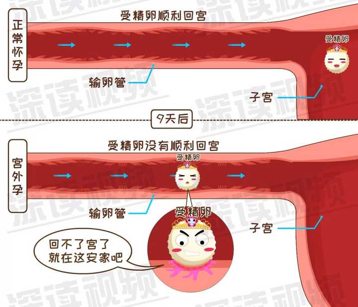 时间内运送受精卵回子宫,受精卵就有可能在输卵管上安家,宫外孕就发生