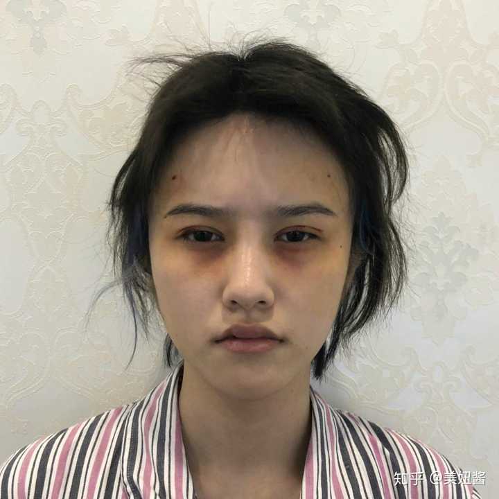 有没有割欧式双眼皮成功案例?