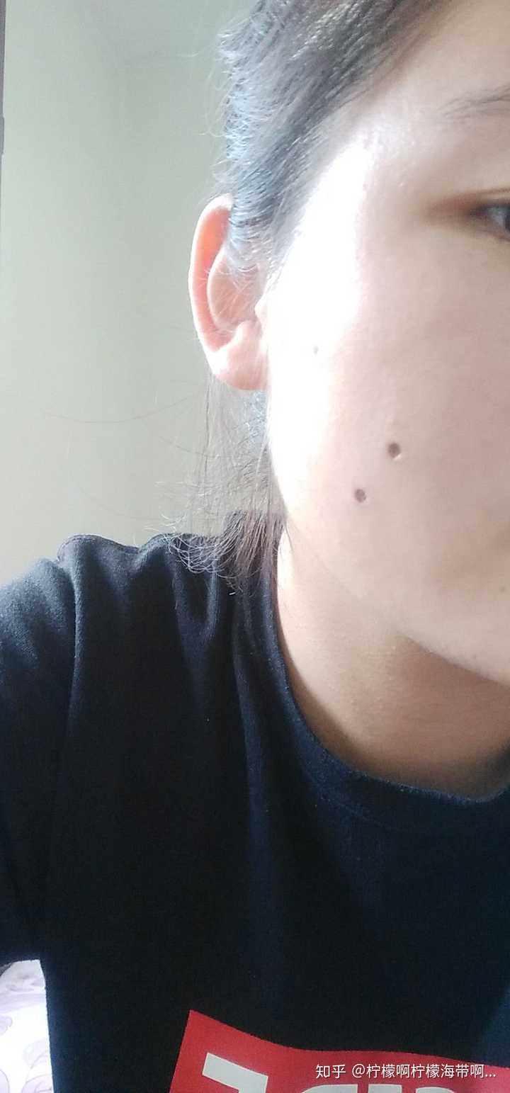 第一天 点完差不多一两个小时就结疤了