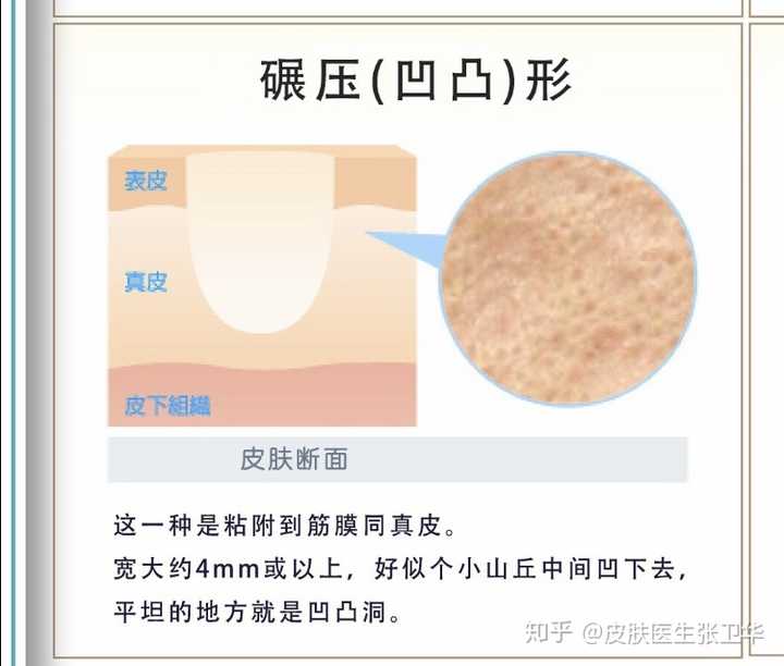 知乎痘坑分为冰锥型,厢车型,碾压型的, 冰锥型的痘坑是最难治疗的一种