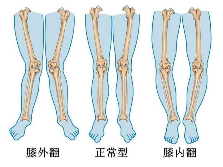 这样的我们一般叫做"膝外翻"膝内翻.