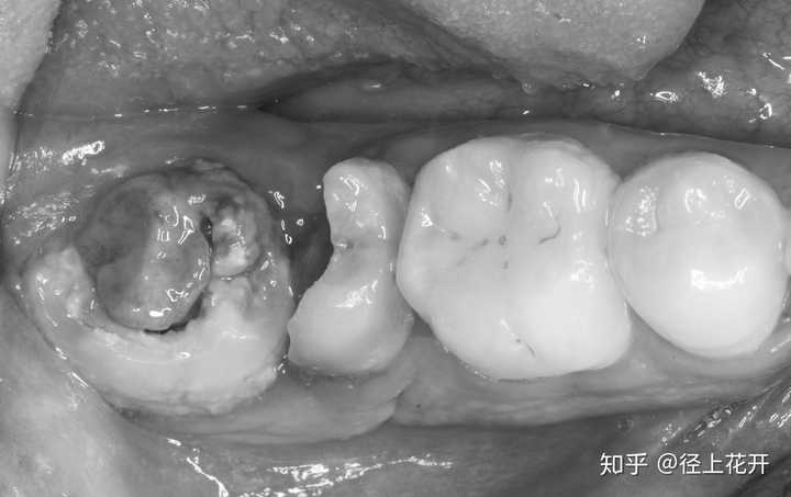 种植牙后亲身体验怎么样?