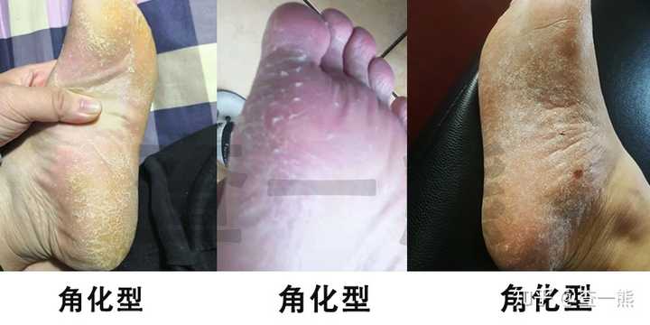 【浸渍型】:当寄生真菌已达真皮层,脚汗增多,脚底出现蜂窝状凹凸.