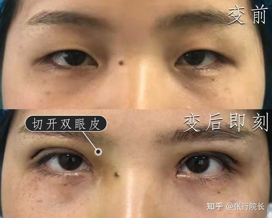 切开双眼皮术前眼皮松弛眼睛无神术后两年恢复的已经非常自然非常漂亮