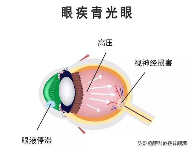 如果突然出现剧烈的眼疼,头疼,视力下降并伴有虹视,就要警惕青光眼