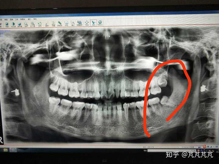 求问如图下边这两颗智齿,都是阻生齿,的拔牙难度?