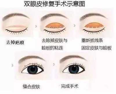 双眼皮修复手术风险大吗?