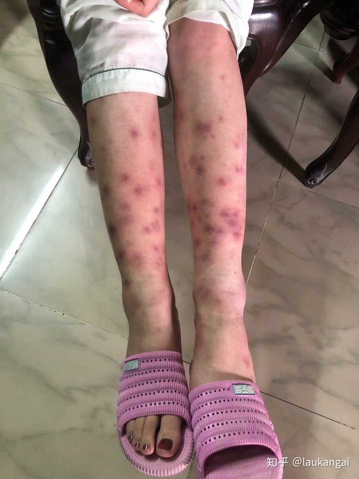 得过结节性红斑的人过来交流下?