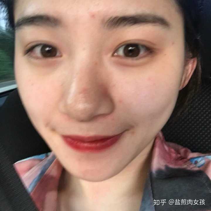 鼻子上黑头严重怎么办?