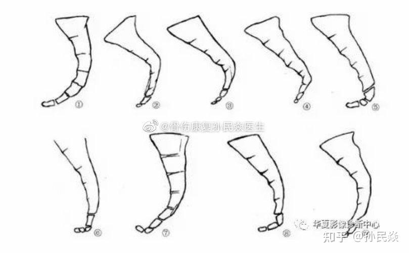 孙民焱 的想法: 今日工作心得 钩状尾椎 hooked coccyx 一… - 知乎