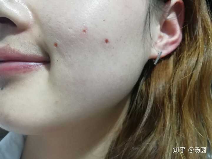 激光点痣祛痣祛斑是什么体验?