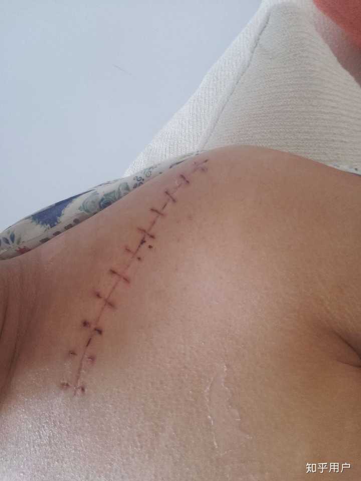 锁骨骨折是一种什么样的体验?