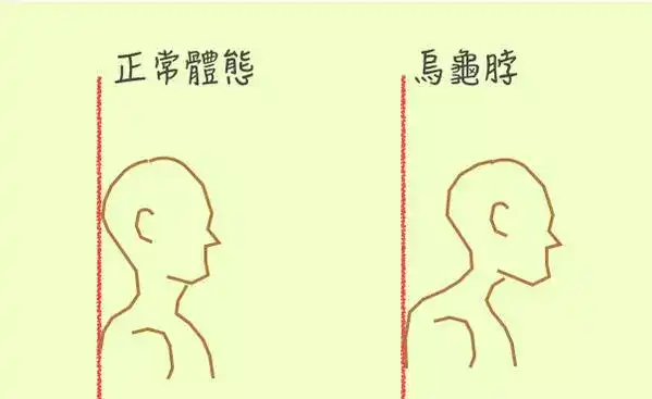 脖子前倾如何解决?