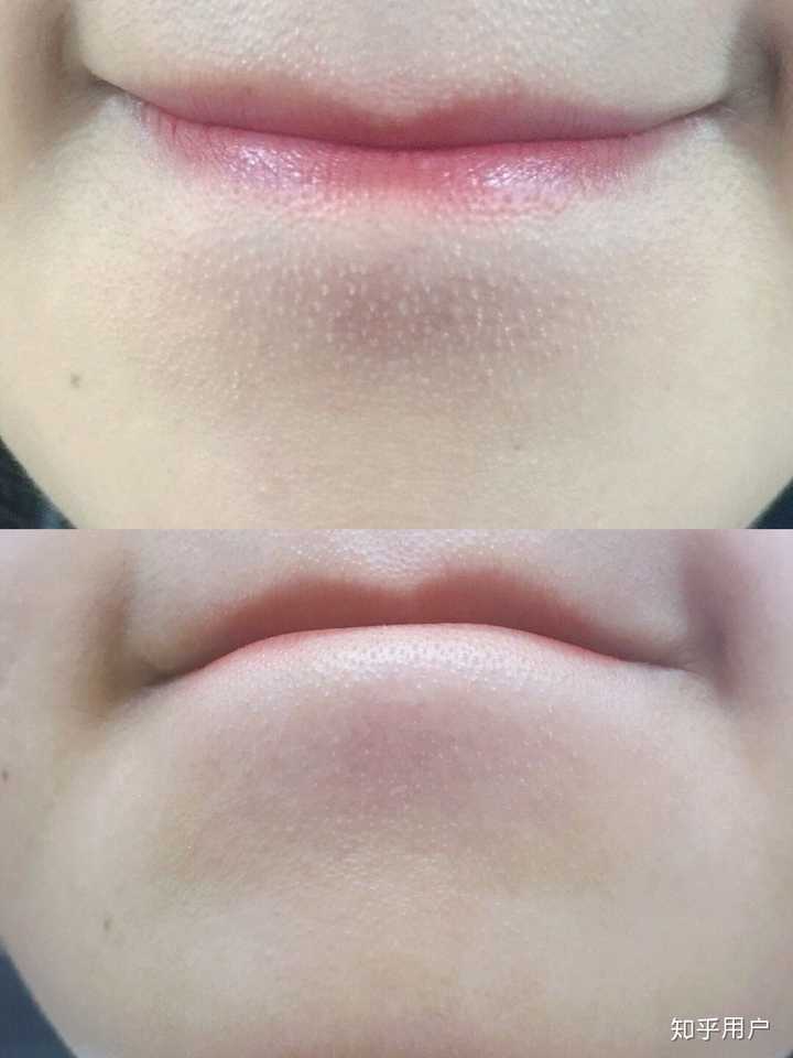 总的这就是我坚持这两点,所以到现在下巴闭口和鼻子上的黑头都已经