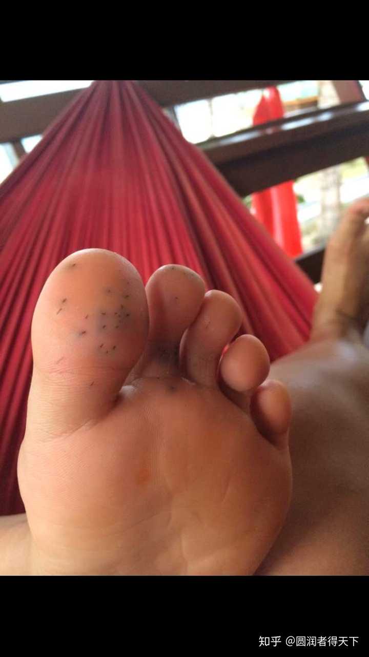 前几天去泰国脚被海胆扎了,当地人把刺砸碎了,用柠檬水涂,次日脚底板