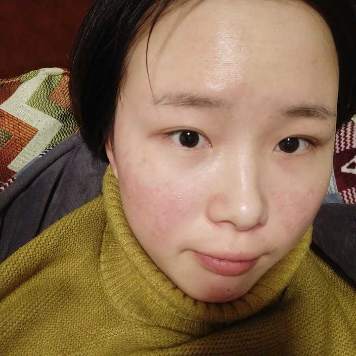 明明可以靠脸吃饭却被痘痘逼得不得不靠实力是种什么体验