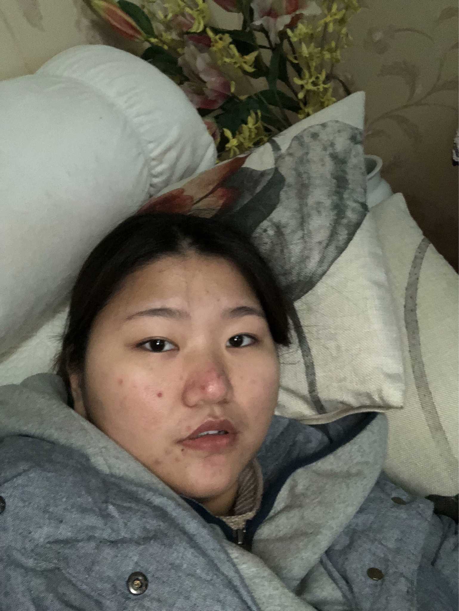 女孩子有酒糟鼻是什么样的体验?