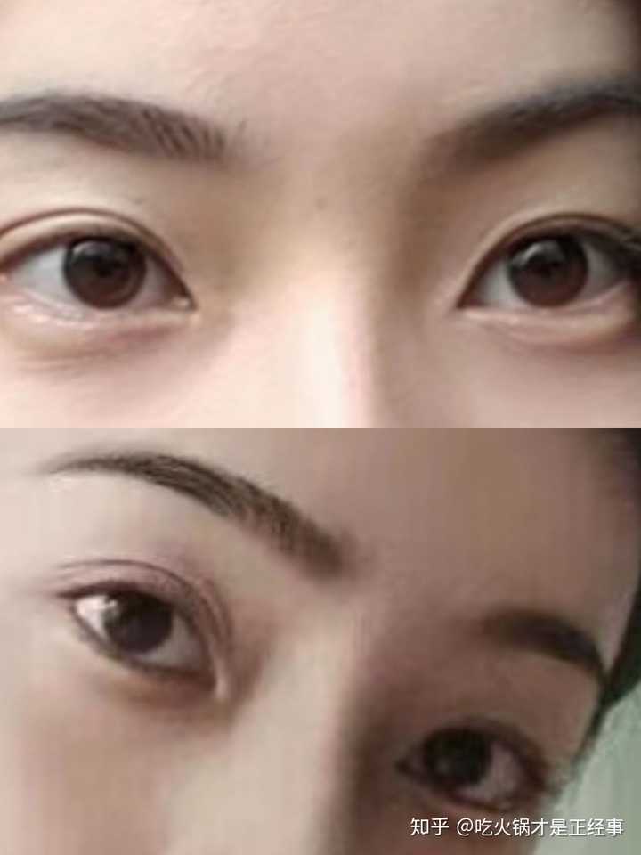 多层眼皮的专业名字叫什么啊遗传规律是什么有什么需要特别注意的么