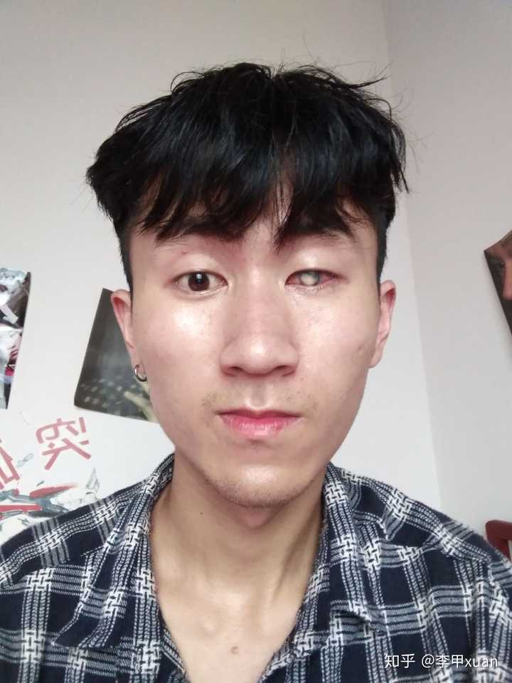 单眼失明是种怎样的体验?