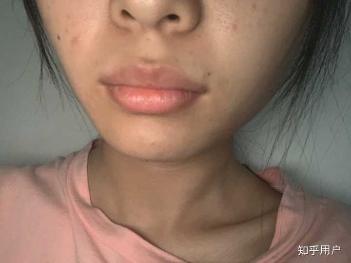 嘴唇厚而且外翻真的超级丑?