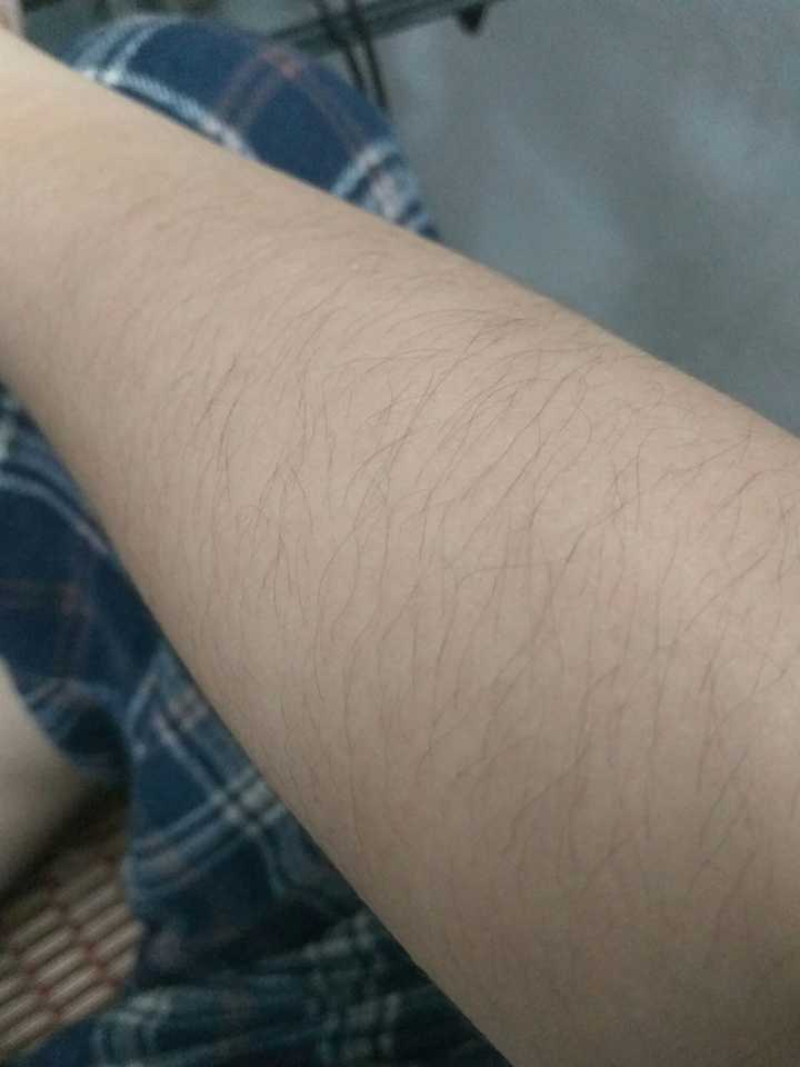 女生汗毛多怎么办?