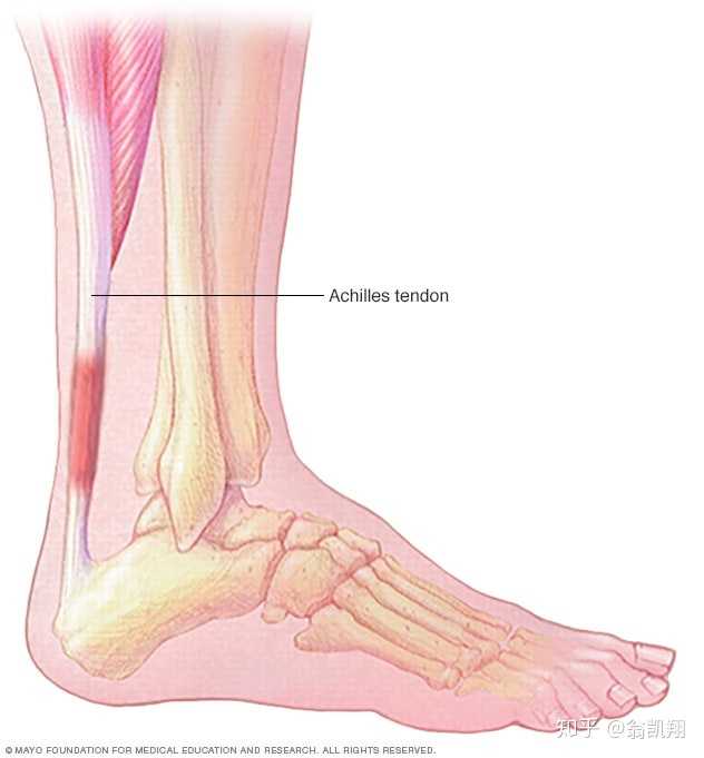 肌腱炎的典型症状是髌骨上方或下方的肌腱部位疼痛蛑肿胀.