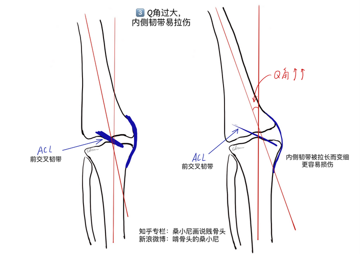 纠正q角,恢复正常的下肢力线也是从"肌群平衡","力学代偿"和"关节稳定