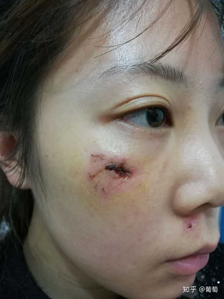 女生脸上有疤是怎样的体验?