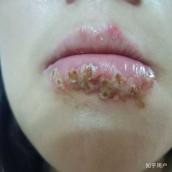 嘴唇可能长疱疹了以后肿了怎么办?