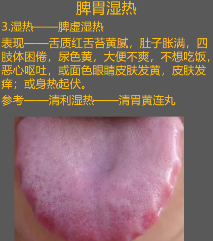 雷师兄健康 的想法: 胖大舌,齿痕舌属于脾虚,脾虚湿气