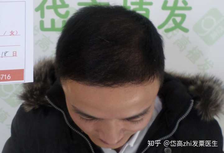 脱发的男人,通过植发手术重新拥有茂盛头发,是一种怎样的体验?
