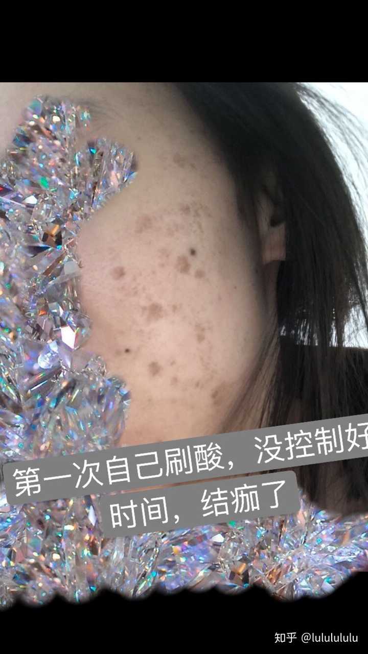 做完果酸换肤后脸上有结渣还要敷面膜吗