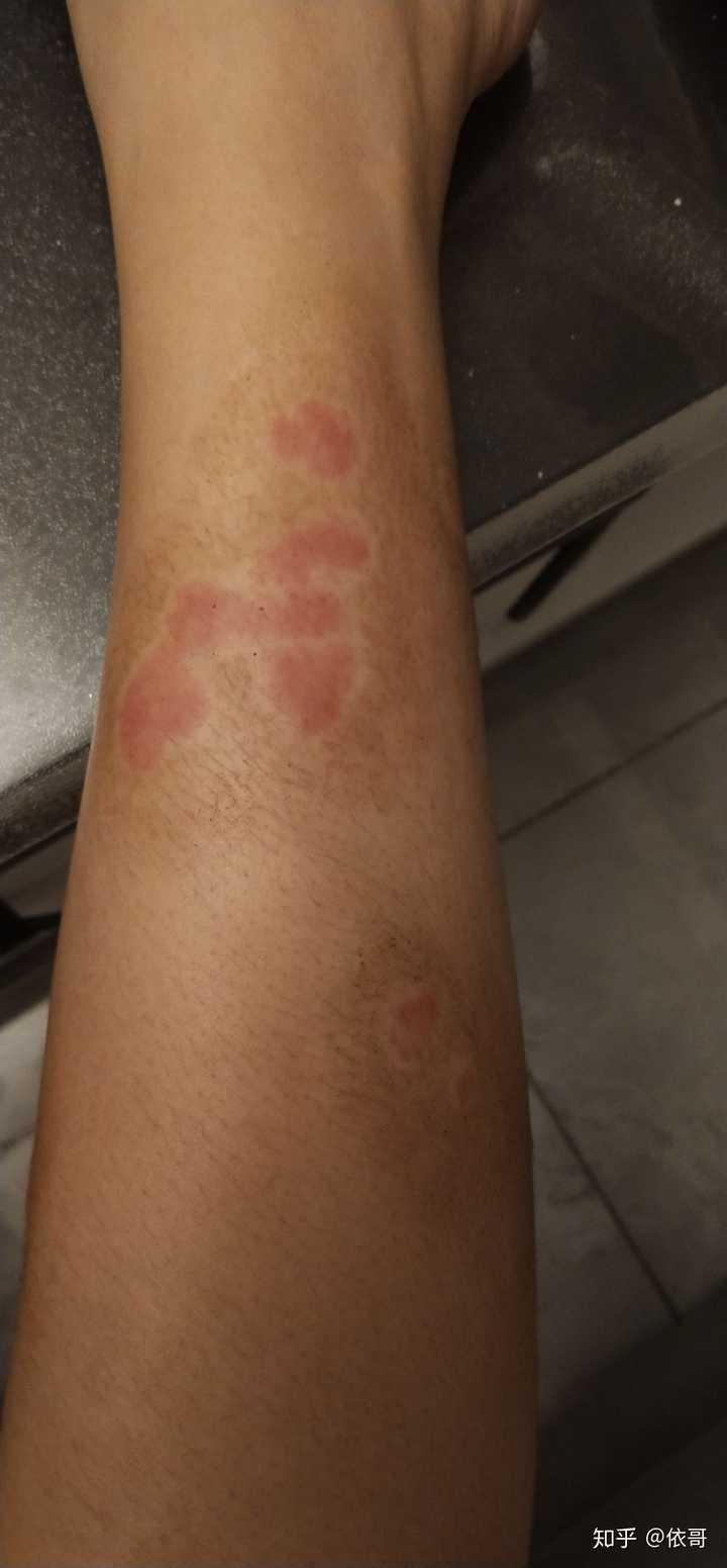 牛皮癣能治疗好吗?
