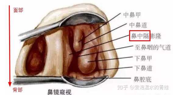 鼻炎到底能否彻底好?