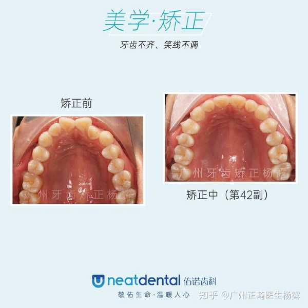 主诉:牙齿不齐,门牙扭转