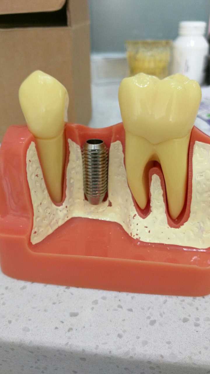 先植入一个人工牙根. 然后三到五个月后开始做修复
