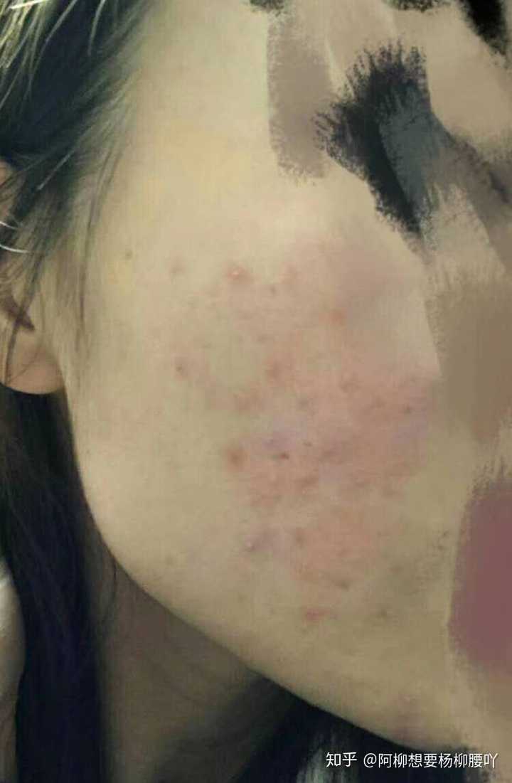 有没有亲身使用过博乐达水杨酸面膜的 ( ) ?
