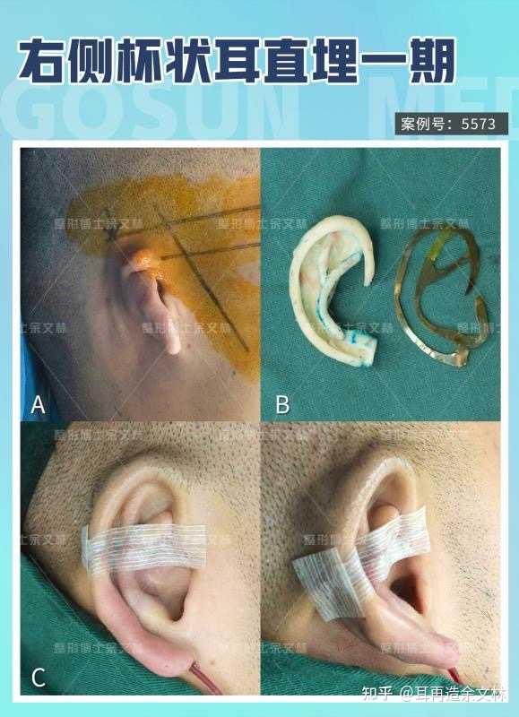 耳再造余文林 的想法 右侧杯状耳矫正(案例 杯状耳是一种介