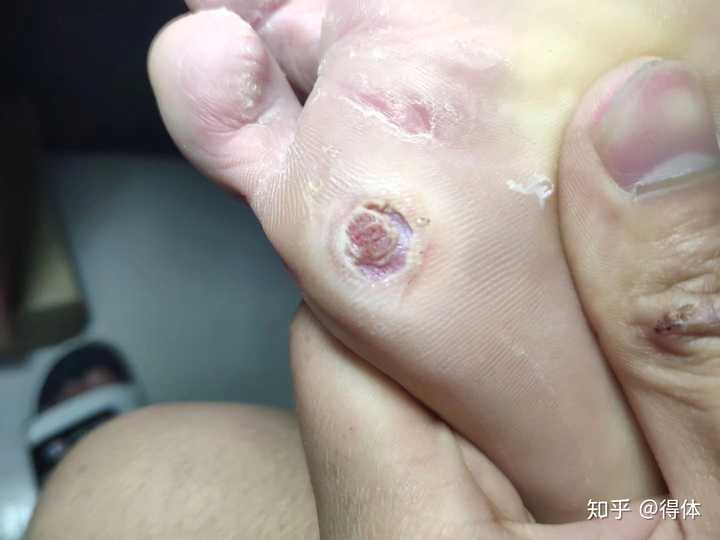 鸡眼怎么彻底挖出?
