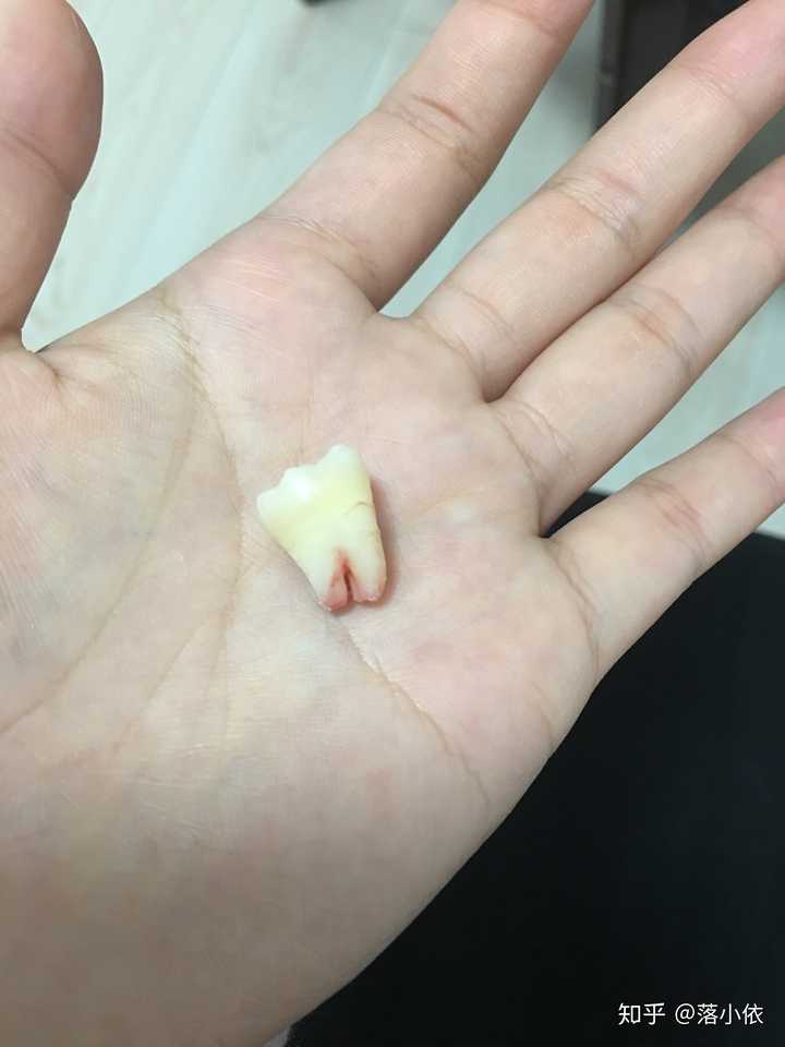 拔下来的智齿怎么处理?怎样保存更美观且不会变质?