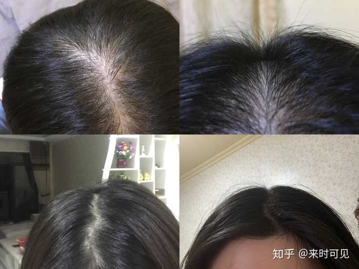 女孩子脱发怎么办 ?