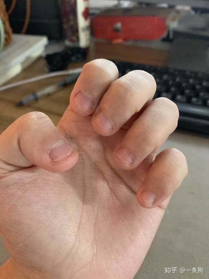 的,完全不控制,想啃就啃的状态,啧啧啧…惨不忍睹,20多年的啃指甲经验